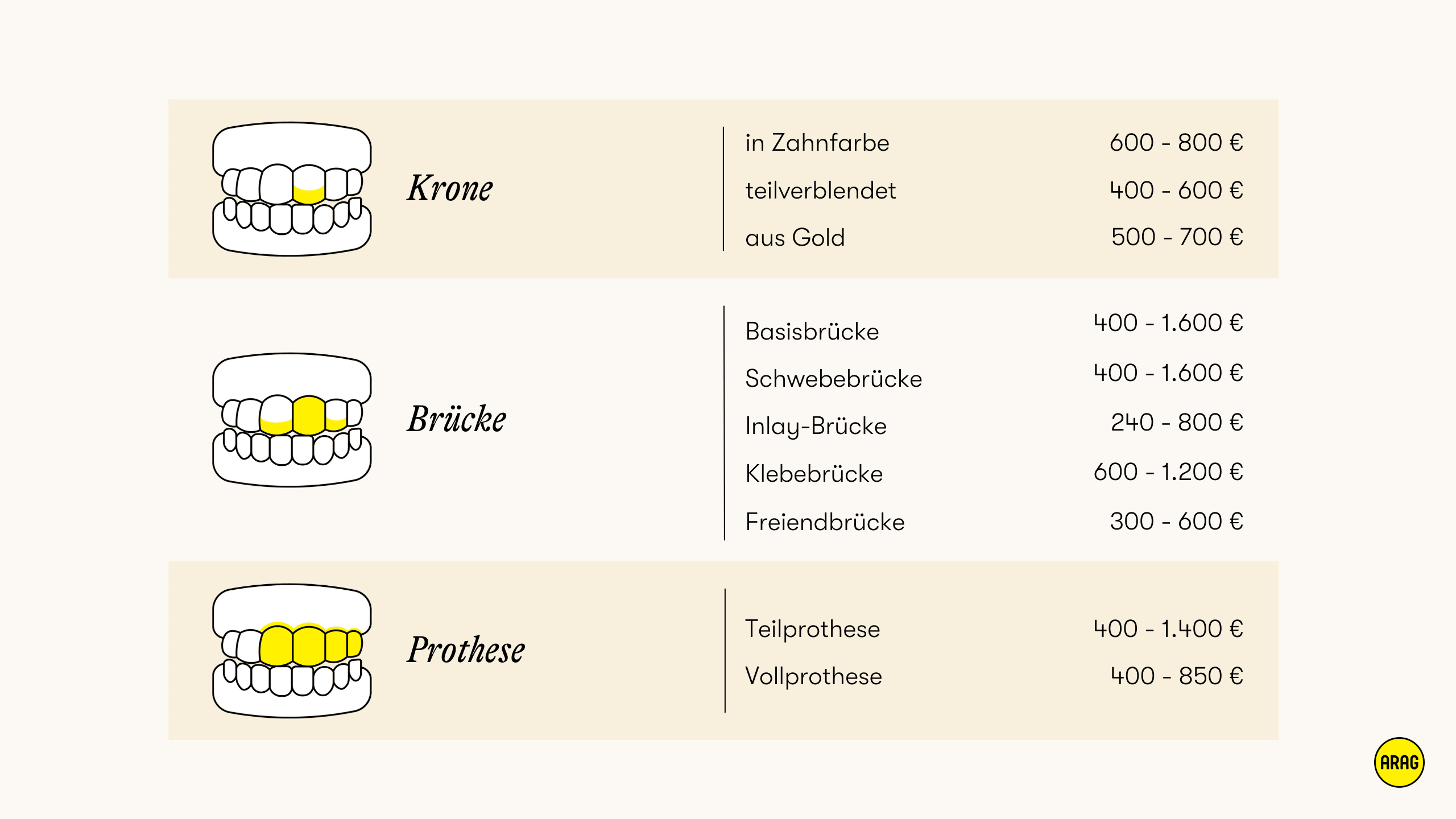 Übersicht zu Zahnersatzarten mit Preisrahmen für Kronen, Brücken und Prothesen.