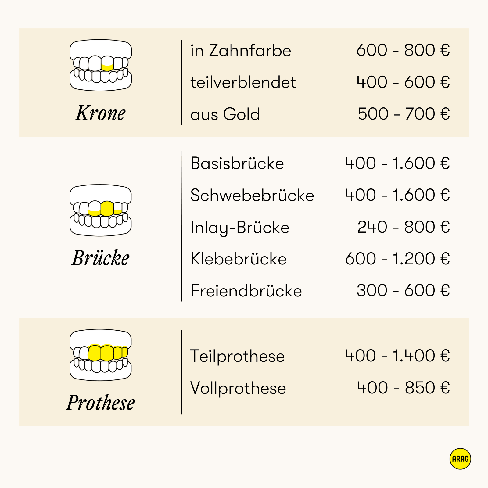 Übersicht zu Zahnersatzarten mit Preisrahmen für Kronen, Brücken und Prothesen.